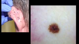 Homogenous blue lesions and many faces of metastatic melanoma by Dr A Marghoob [upl. by Morel]