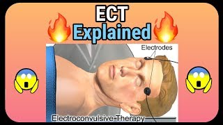 Electroconvulsive therapy ECT explained  How it is performed [upl. by Erusaert]