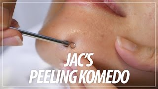 JACs Peeling Komedo [upl. by Hagen574]