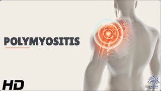 Polymyositis Understanding the Rare Autoimmune Disease [upl. by Arrad]