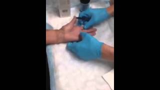 Trigger finger injection  Auburn Medical Group [upl. by Mehalek]