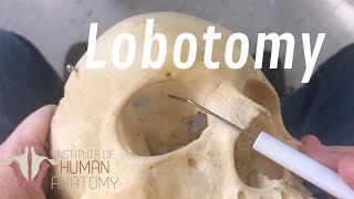 The Anatomy of a Lobotomy [upl. by Odelet889]