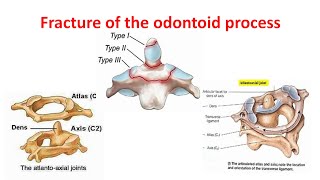 Fracture of the dens Odontoid process Classification clinical features amp treatment [upl. by Aynodal959]