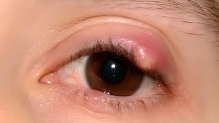 Chalazion Cyst [upl. by Eannej264]