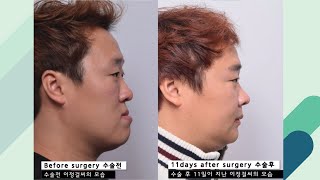 Class 3 Malocclusion Treatment amp Surgery Post OP 11 DAYS [upl. by Gipps]