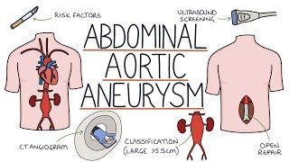 Understanding Abdominal Aortic Aneurysms [upl. by Wehttam251]