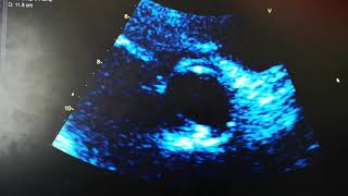 Bicuspid Aortic Valve Transthoracic Echocardiography [upl. by Enixam]