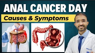 What Is Anal Cancer  Symptoms amp Causes Of Anal Cancer  Dr Bharat Patodiya [upl. by Oigile]