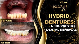 Hybrid Dentures A Journey to Dental Renewal [upl. by Enelym]