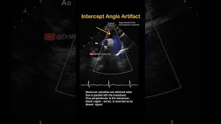 Intercept Angle Artifact on Echocardiography echocardiogram echo ultrasound ARDMS [upl. by Drarreg472]