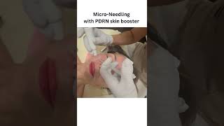 Micro Needling with PDRN skin booster [upl. by Ragg]