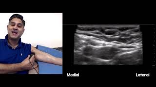 Medial Antebrachial Cutaneous Nerve block medial cutaneous nerve of the forearm [upl. by Ishmul]