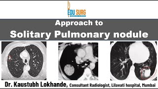 Solitary pulmonary nodule  When to suspect lung cancer  characteristics and follow up  Approach [upl. by Flagler]