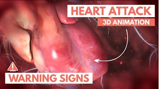 Recognizing a heart attack  3D Animation [upl. by Oirromed]