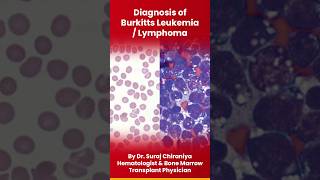 Diagnosis of Burkitts Leukemia or Lymphoma burkitt leukemia lymphocytes lymphoma bloodcancer [upl. by Ellerret]