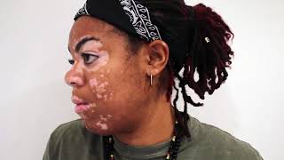 EXPOSE ME  In conversation with Rochelle Richards her journey with Vitiligo [upl. by Neeven]