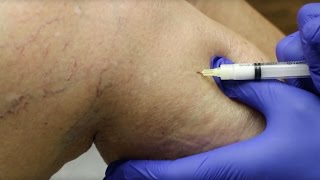 Sclerotherapy Varicose Veins Treatment [upl. by Auburn173]