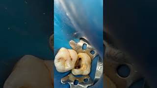 Molar 🦷 root canal treatment dentist dental dentalprocedure [upl. by Mcclelland]