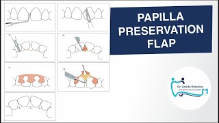 PAPILLA PRESERVATION FLAP PERIODONTAL FLAP SURGICAL TECHNIQUE DR ANKITA KOTECHA [upl. by Clarabelle719]