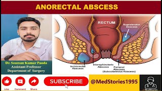 Anorectal Abscess Lecture [upl. by Daniele981]