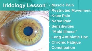 Iridology  The Key to Solving Chronic Pain Through Detoxification [upl. by Ikkela497]