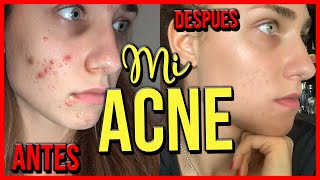 Mi experiencia con ROACCUTAN Mes 1  Mi ACNE  Juli Berea [upl. by Lindell447]