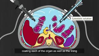 Pressurized Intraperitoneal Aerosol Chemotherapy PIPAC  Peritoneal Carcinomatosis Patients [upl. by Accebor]