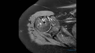 Subcoracoid impingement in 60 year old [upl. by Lirpa]