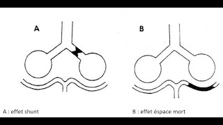 Effet shunt et effet espace mort QUELLE EST LA DIFFÉRENCE [upl. by Enatan564]
