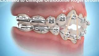 Port délastiques en orthodontie [upl. by Ecyrb652]