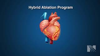 Atrial Fibrillation Treatment Hybrid Atrial Fibrillation AF Ablation [upl. by Gusti]