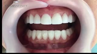 Smile MakeoverHollywood Smile trial By Smile Infinity® [upl. by Annahgiel]