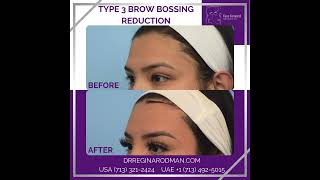 Brow Bossing Reduction [upl. by Airal]