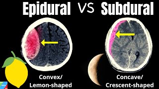 Subdural Hematoma VS Epidural Hematoma  Intracranial Hemorrhages [upl. by Eninnaj834]