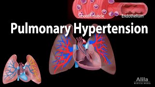 Pulmonary Hypertension Animation [upl. by Kryska]