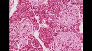 Histopathology Pancreas Type 2 Diabetes mellitus [upl. by Dugan116]