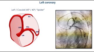 Angiographic projections angioplasty cardiology cardiologyfellow unam anahuac medicina [upl. by Novek188]