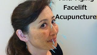 AntiAging Facelift Acupuncture  Massage Monday 227 [upl. by Notsyrb996]