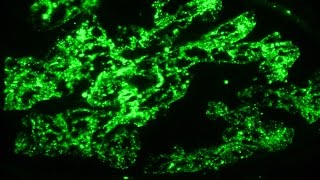 Nephritic syndrome and post infectious glomerulonephritis  Pathology mini tutorial [upl. by Rosana59]