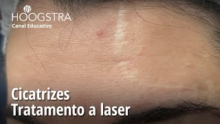 Cicatrizes  Tratamento a laser  24003 [upl. by Piselli]