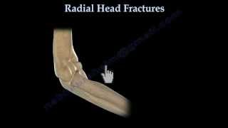 Radial Head Fracture Everything You Need To Know Dr Nabil Ebraheim [upl. by Dari327]