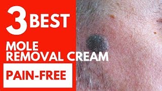 Top 3 Best mole removal creamSurgical Alternative and painfree [upl. by Hamforrd]