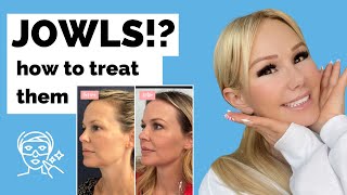 JOWLS How to treat them without surgery Thermafrax thread lifts fillers botox more [upl. by Eserrehs599]