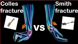 Colles fracture VS Smith fracture [upl. by Damour]