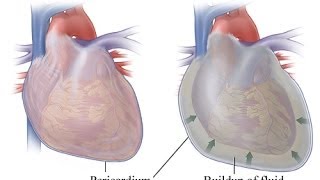 My Pericarditis or Heart Fluid Buildup I think it was caused by an infection It happened suddenly [upl. by Neerual]