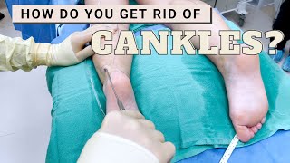 Get Rid of Cankles with High Definition Calf Liposuction  Barrett Plastic Surgery [upl. by Yemirej]