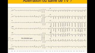 Tachycardie ventriculaire ou supraventriculaire  Quiz ECG Dr Taboulet [upl. by Hew907]