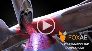 Laminectomy  Legal Animation  Surgery Demonstration [upl. by Jer]