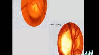 Practical Ophthalmology  Glaucoma amp Lacrimal Slides [upl. by Retla932]