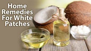 Home Remedies For White PatchesLeucoderma [upl. by Oicram507]